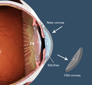 keratoplasty, keratoplasty surgery, keratoplasty cornea transplant, cornea transplant surgery, cornea transplant