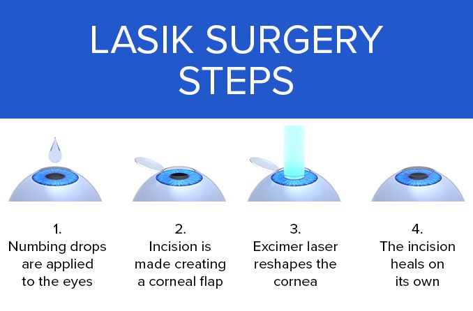 LASIK Laser Eye Surgery, LASIK, Laser Eye Surgery