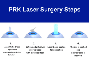 PRK Laser Eye Surgery Steps, PRK Laser Surgery, PRK Laser Eye Surgery
