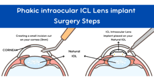 Phakic Lens Surgery, Phakic ICL Lens Surgery, Phakic Interocular Collamer Lens