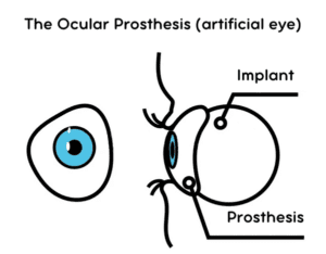 The Ocular Prosthesis, artificial eye, Enucleation, Evisceration
