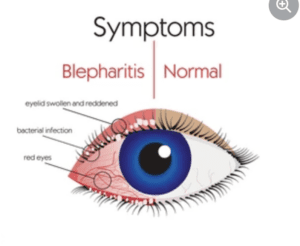 blepharitis, blepharitis treatment