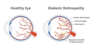 diabetic retinopathy