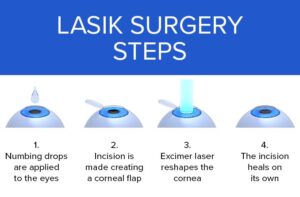 Presbyopia LASIK Surgery Steps, Presbyopia LASIK Smart Laser Eye Surgery, Presbyopia LASIK Smart Laser Eye treatment,