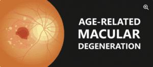 Age-related macular degeneration, AMD, macular degeneration