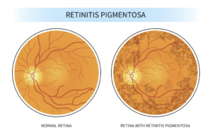 Retinitis pigmentosa, Night blindness, Retinitis pigmentosa treatment, Wharton’s jelly-derived mesenchymal stem cells