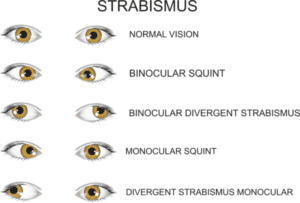Crosses eye, cross eyed, squint, Strabismus, Crosses eye surgery, cross eyed surgery, Strabismus surgery