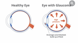 Причини випадання очей: хвороба і травма