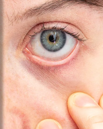 Pterygium, Pterygium kirurgi