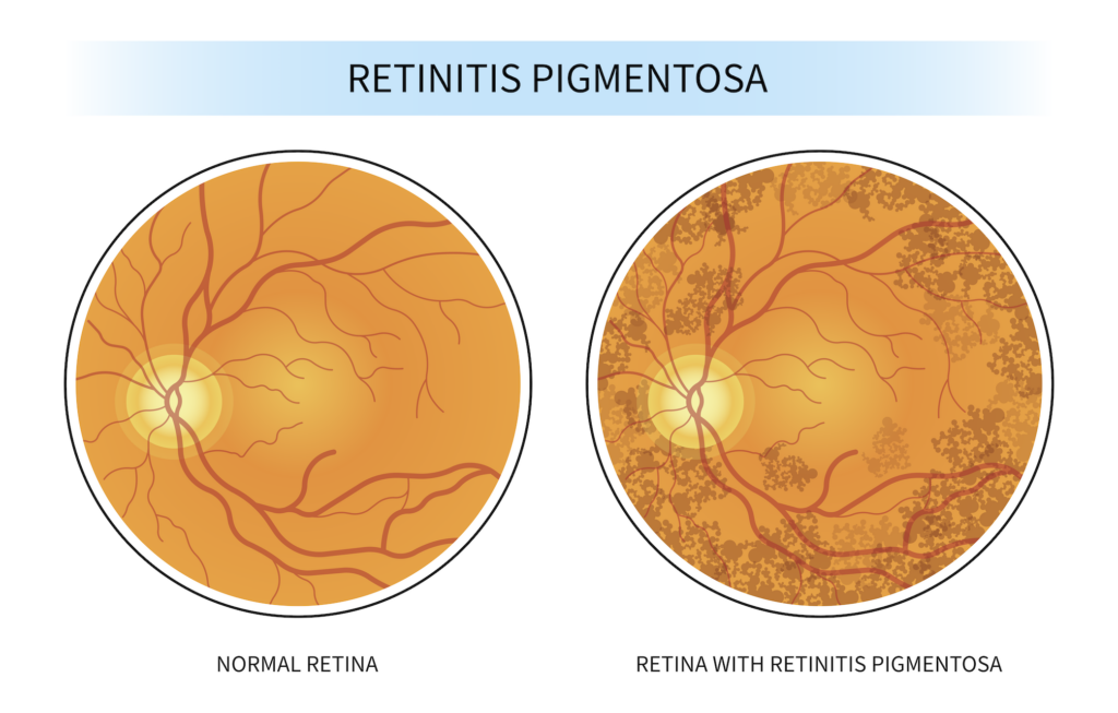 Leczenie Retinitis Pigmentosa Smart Laser Eye Center